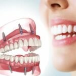 What to Know About Full-Mouth Dental Implants: Benefits, Options, and Patient Experiences