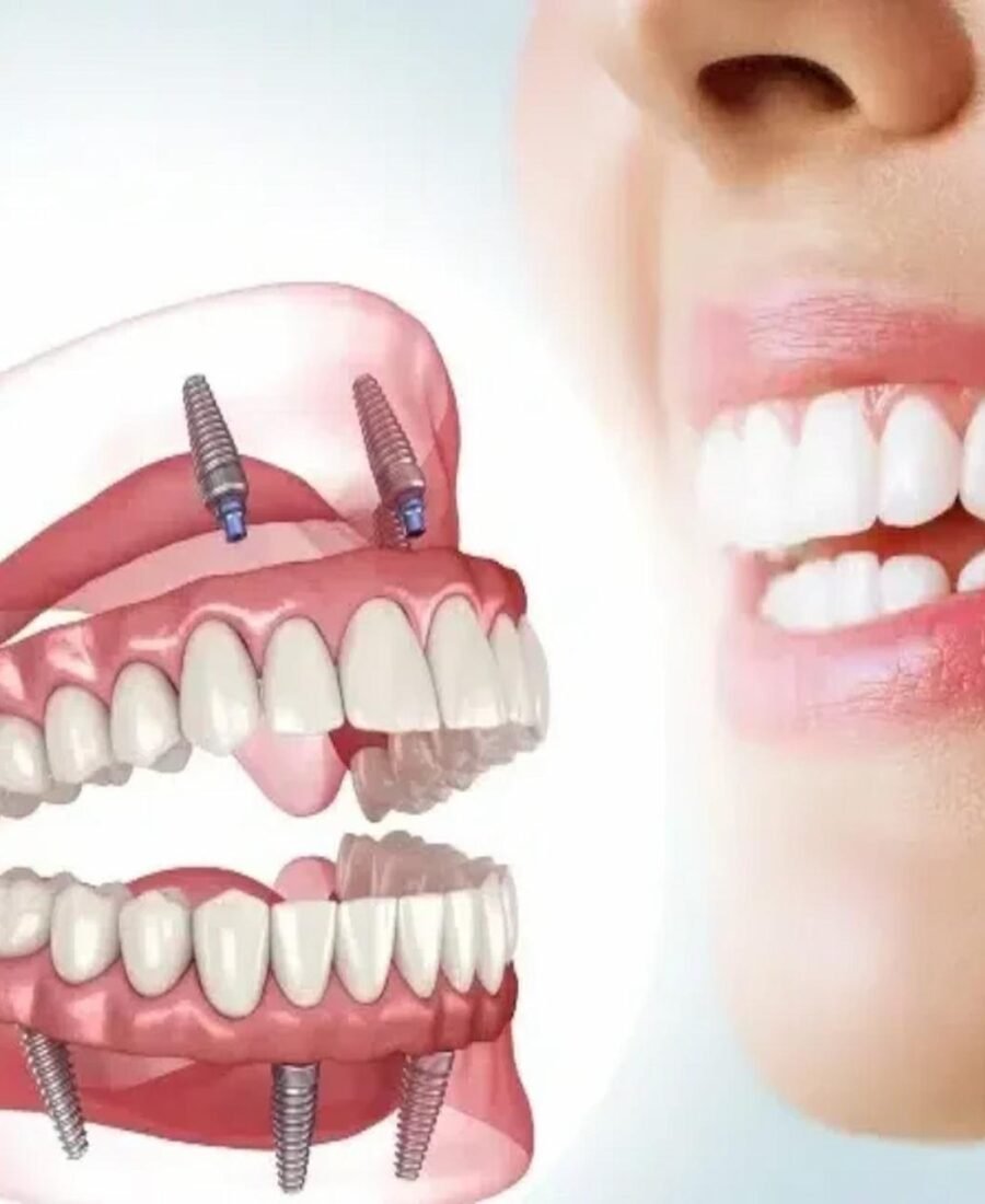 What to Know About Full-Mouth Dental Implants: Benefits, Options, and Patient Experiences