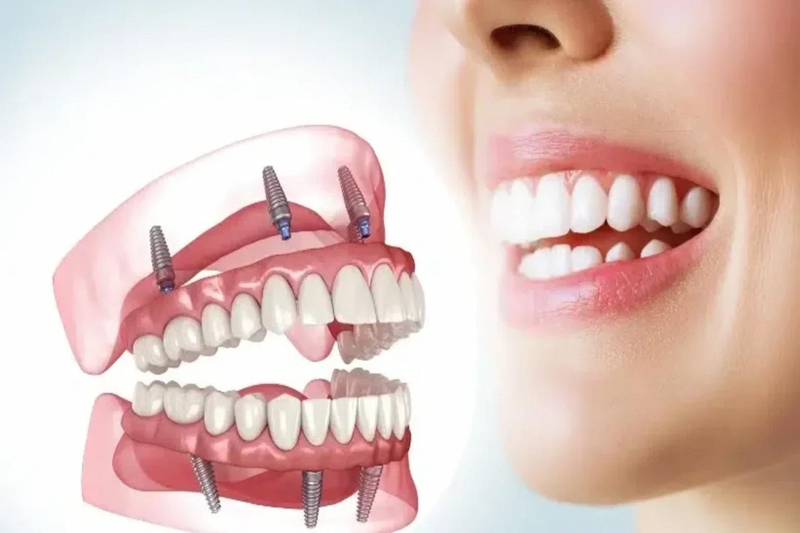 What to Know About Full-Mouth Dental Implants: Benefits, Options, and Patient Experiences