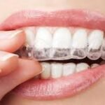 How Clear Aligners Support Dental Goals for Las Vegas Professionals