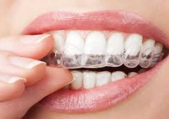 How Clear Aligners Support Dental Goals for Las Vegas Professionals