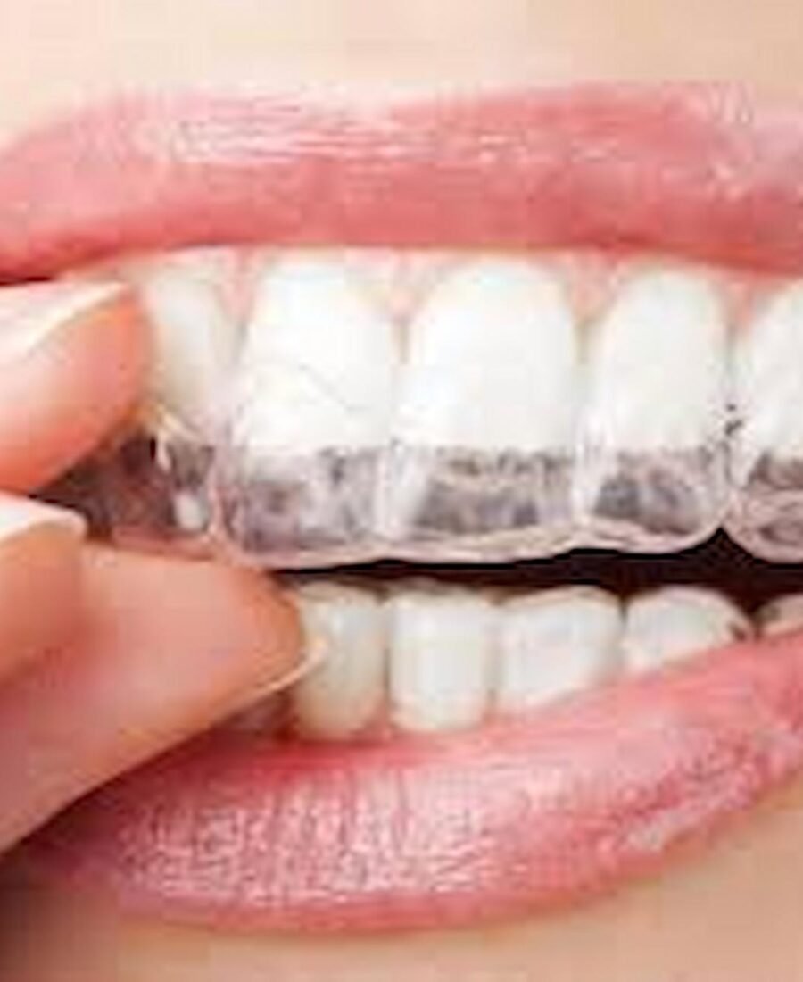 How Clear Aligners Support Dental Goals for Las Vegas Professionals