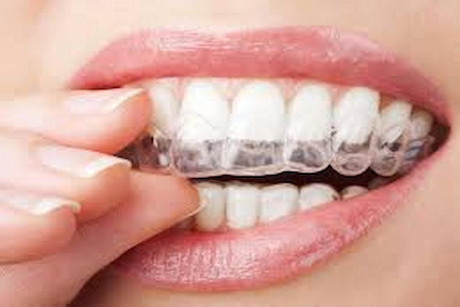 How Clear Aligners Support Dental Goals for Las Vegas Professionals