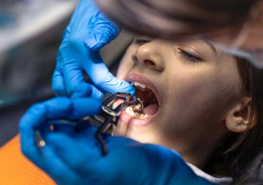How Pediatric Dentists in Overland Park Treat Cavities Hidden Between Two Touching Molars