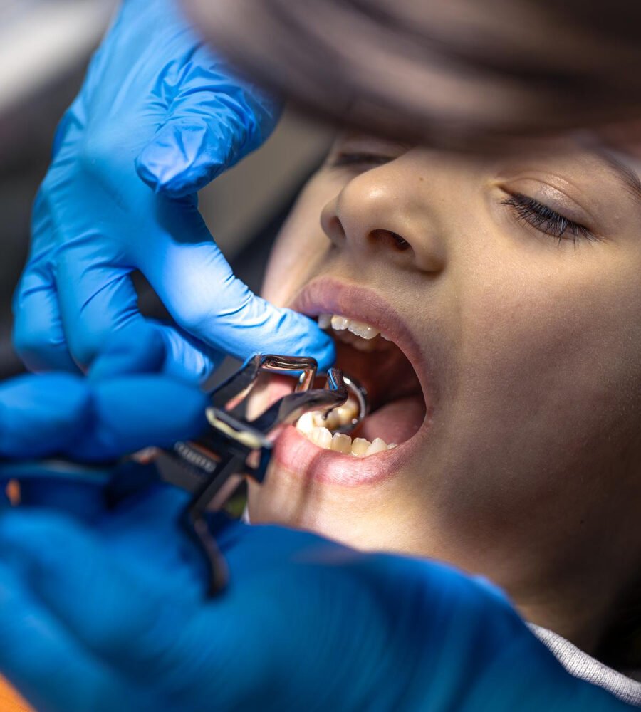 How Pediatric Dentists in Overland Park Treat Cavities Hidden Between Two Touching Molars