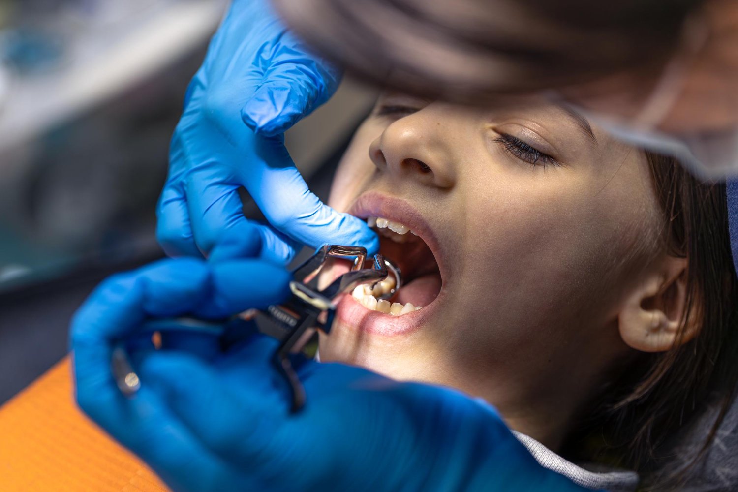 How Pediatric Dentists in Overland Park Treat Cavities Hidden Between Two Touching Molars