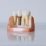 How to Prepare for a Tooth Replacement Consultation