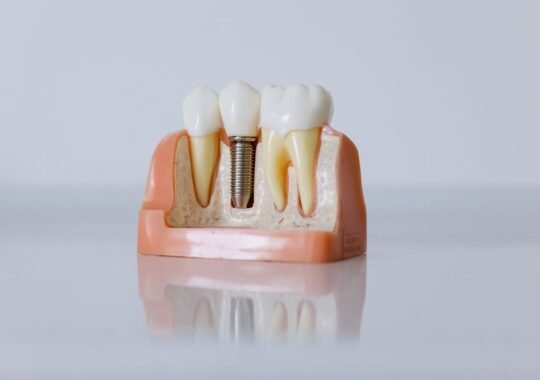 How to Prepare for a Tooth Replacement Consultation