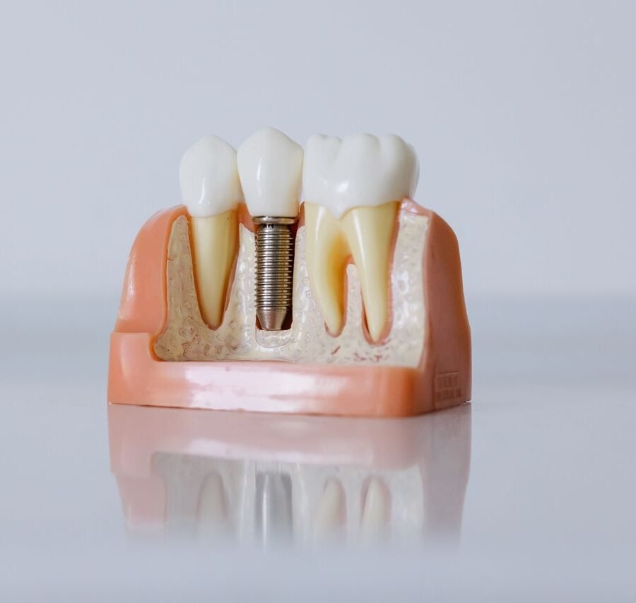 How to Prepare for a Tooth Replacement Consultation