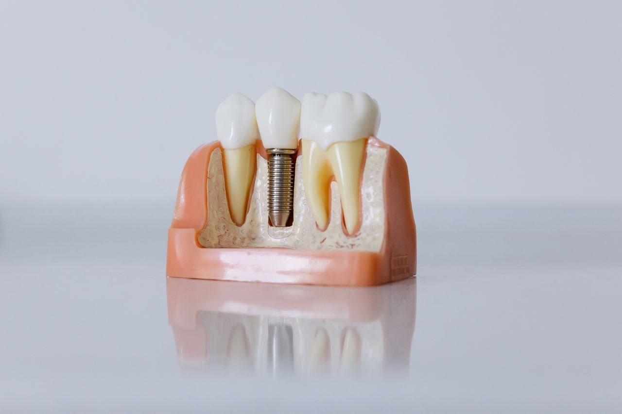 How to Prepare for a Tooth Replacement Consultation