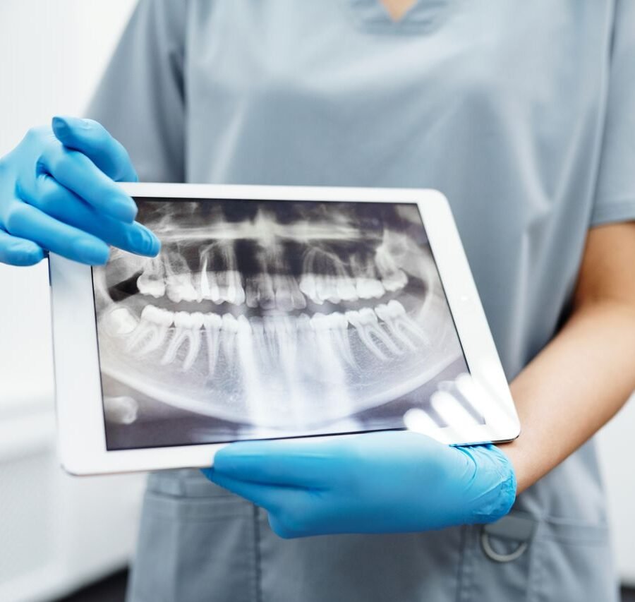 What You Should Know About Root Canal Costs Before You Book an Appointment