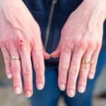 What Does a Bat Bite Look Like? Signs, Symptoms and What to Do