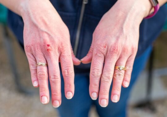 What Does a Bat Bite Look Like? Signs, Symptoms and What to Do