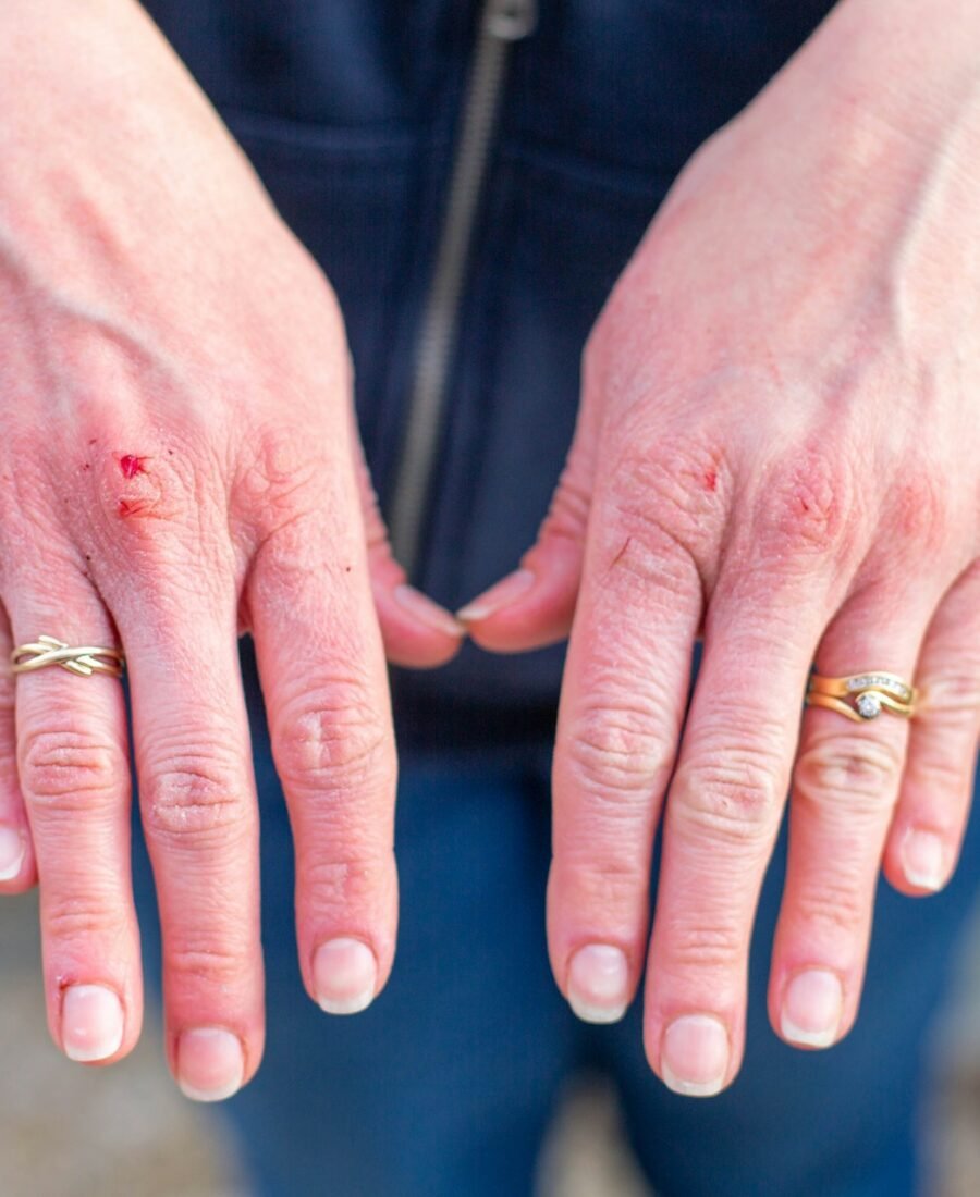 What Does a Bat Bite Look Like? Signs, Symptoms and What to Do