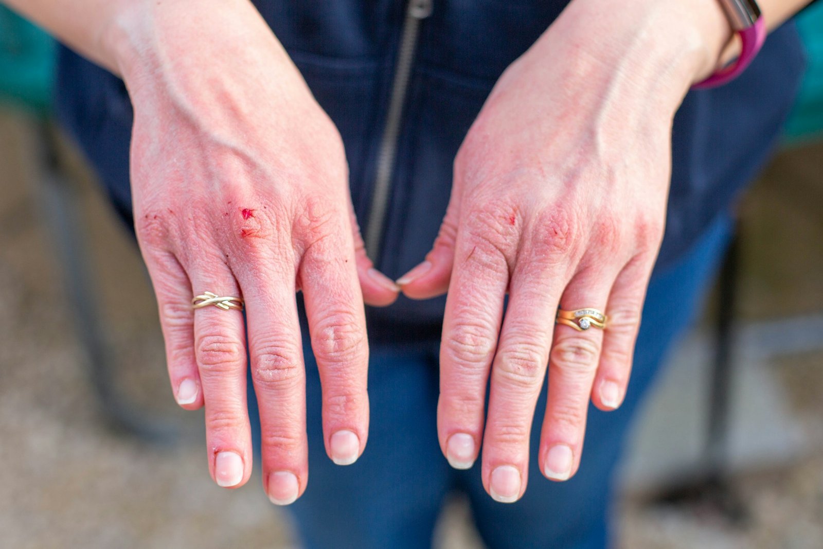 What Does a Bat Bite Look Like? Signs, Symptoms and What to Do